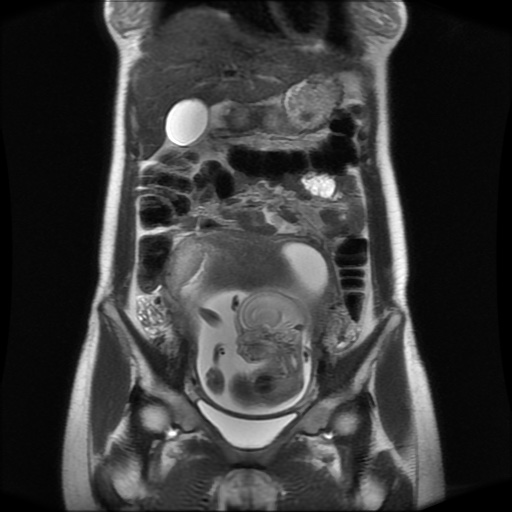 File:Normal MRI abdomen in pregnancy (Radiopaedia 88001-104541 Coronal T2 13).jpg