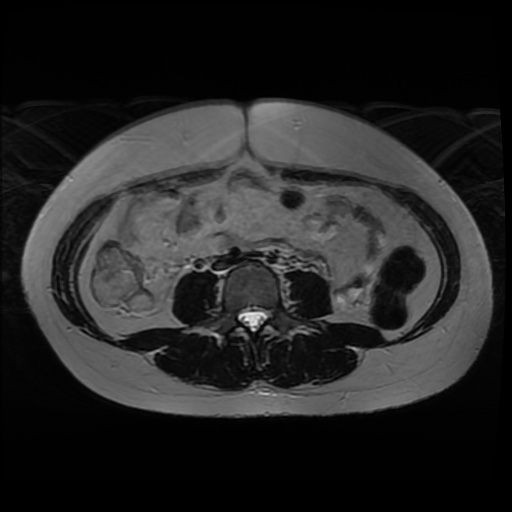 Normal MRI abdomen in pregnancy (Radiopaedia 88005-104548 Axial T2 2).jpg