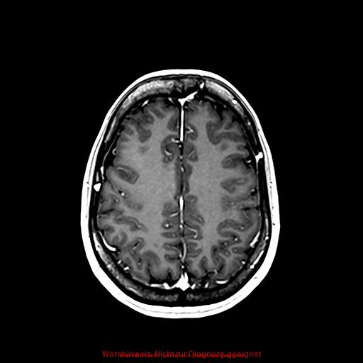 Normal adult brain MRI (non-enhanced and contrast-enhanced) (Radiopaedia 75262-86379 Axial T1 C+ 136).jpg