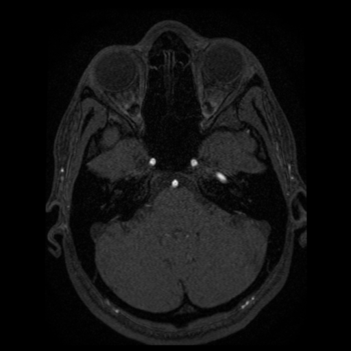 Normal brain MRA (Radiopaedia 41046-43793 Axial MRA 88).png