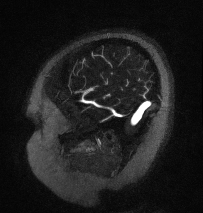 Normal brain MRI and venogram (Radiopaedia 39554-41862 Sagittal MRV 61).jpg