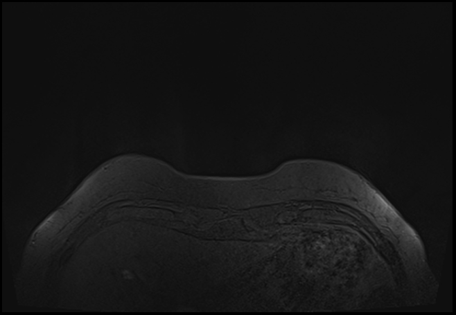 File:Normal breast MRI - dense breasts (Radiopaedia 80454-93850 Axial T1 7).jpg