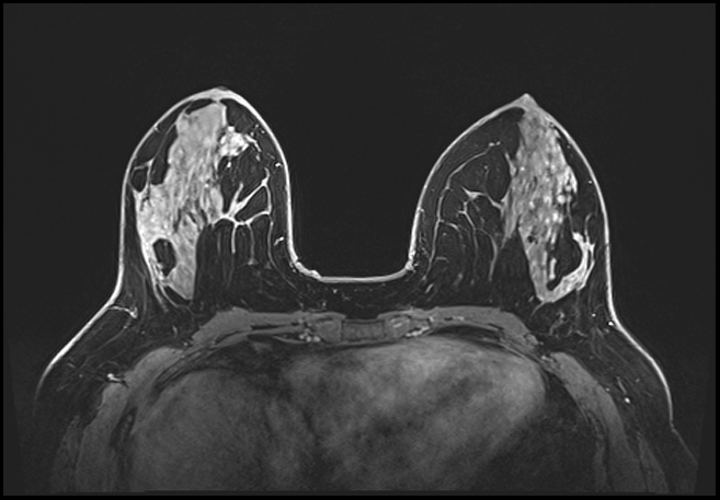 Normal breast MRI - dense breasts (Radiopaedia 80454-93850 C 96).jpg