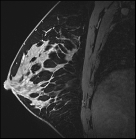 Normal breast MRI - dense breasts (Radiopaedia 80454-93850 I 110).jpg