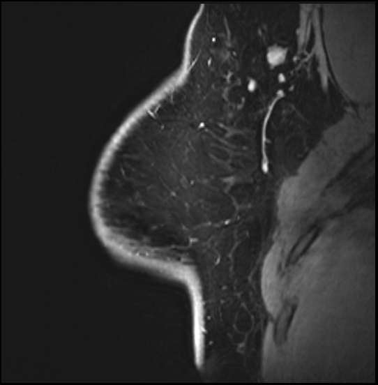 Normal breast MRI - dense breasts (Radiopaedia 80454-93850 I 47).jpg