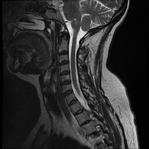File:Normal cervical and thoracic spine MRI (Radiopaedia 35630-37156 Sagittal T2 5).png