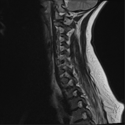 File:Normal cervical spine MRI (including Dixon) (Radiopaedia 42762-45925 Dixon- in-phase 12).png