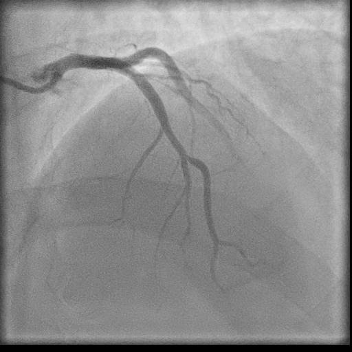 Normal coronary angiogram (DSA) (Radiopaedia 63081-71571 E 23).jpg