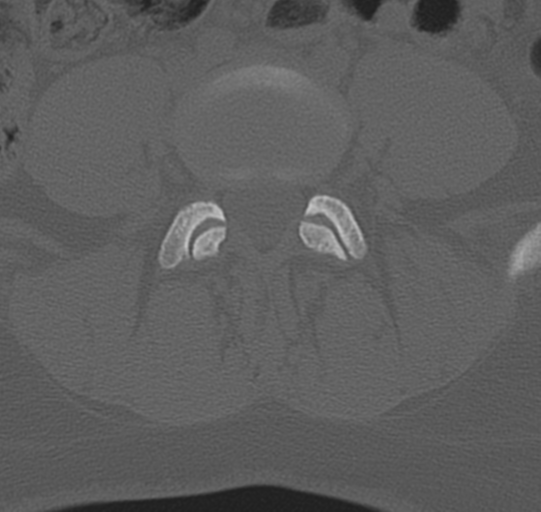 File:Normal lumbar spine CT (Radiopaedia 46533-50986 Axial bone window 54).png
