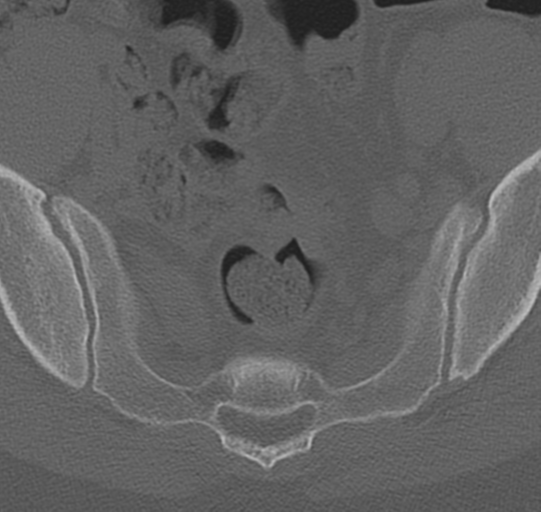File:Normal lumbar spine CT (Radiopaedia 46533-50986 Axial bone window 79).png