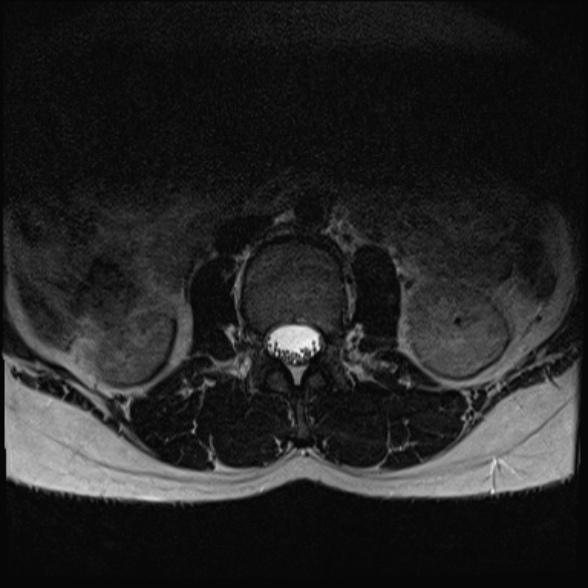 File:Normal lumbar spine MRI- 3 T (Radiopaedia 53280-59250 Axial T2 1).jpg
