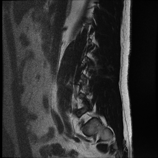 File:Normal lumbar spine MRI (Radiopaedia 35543-37039 Sagittal T2 12).png