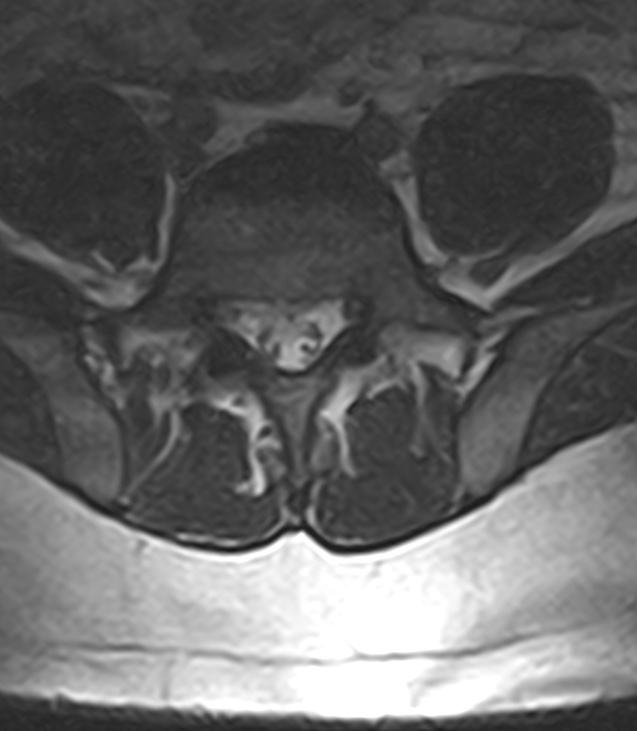 Normal lumbar spine MRI - low-field MRI scanner (Radiopaedia 40976-43699 Axial T2 81).jpg