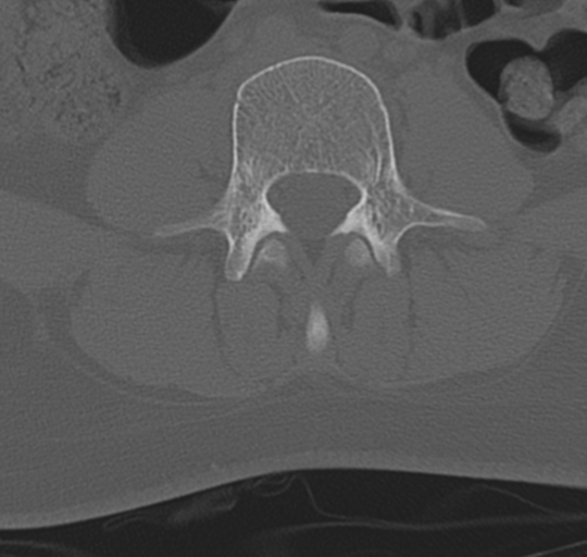 File:Normal lumbosacral CT (Radiopaedia 37923-39867 Axial bone window 61).png