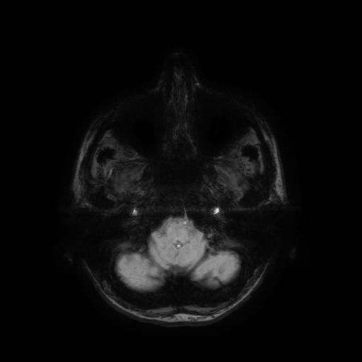 Normal noncontrast MR venography (Radiopaedia 87578-103957 Axial SWI 67).jpg