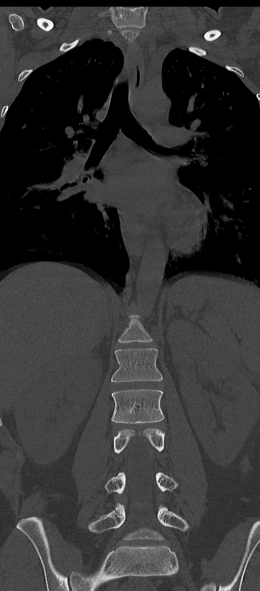 Normal thoracolumbar spine (Radiopaedia 43822-47309 Coronal bone window 42).png