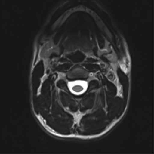 Normal trauma cervical spine (Radiopaedia 41017-43762 D 8).png