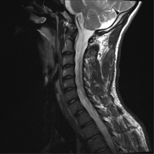 File:Normal trauma cervical spine (Radiopaedia 41017-43762 Sagittal T2 10).png