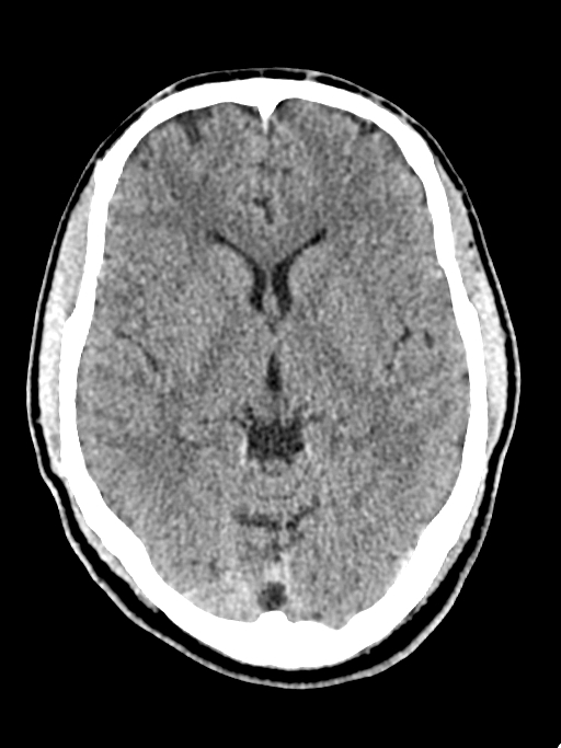 Normal trauma protocol brain and C-spine CT (Radiopaedia 83302-97709 Axial non-contrast 41).jpg