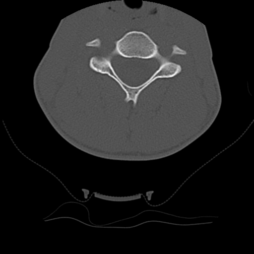 Normal trauma spine imaging (age 16) (Radiopaedia 45335-49358 Axial bone window 39).jpg