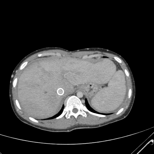 File:Nutmeg liver- Budd-Chiari syndrome (Radiopaedia 46234-50635 B 12).png