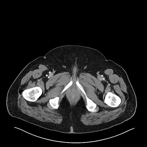Obstructing sigmoid adenocarcinoma (Radiopaedia 58465-65619 A 171).jpg
