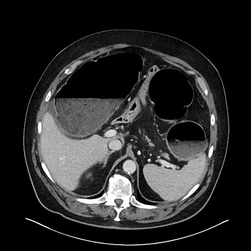 Obstructing sigmoid adenocarcinoma (Radiopaedia 58465-65619 A 44).jpg