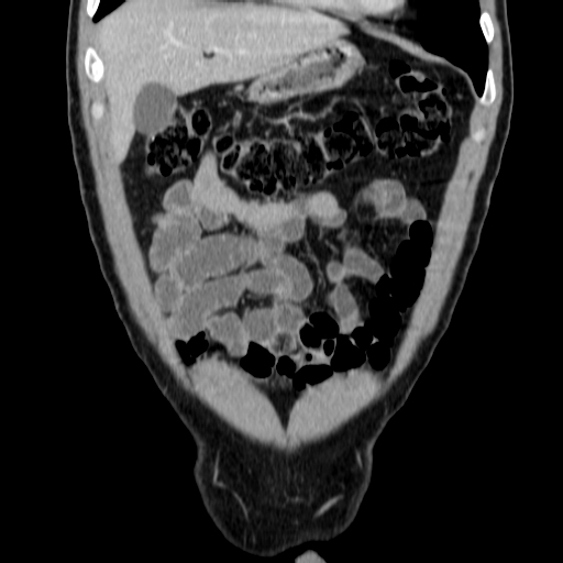 File:Obstructing ureteric calculus (Radiopaedia 18615-18514 C 15).jpg