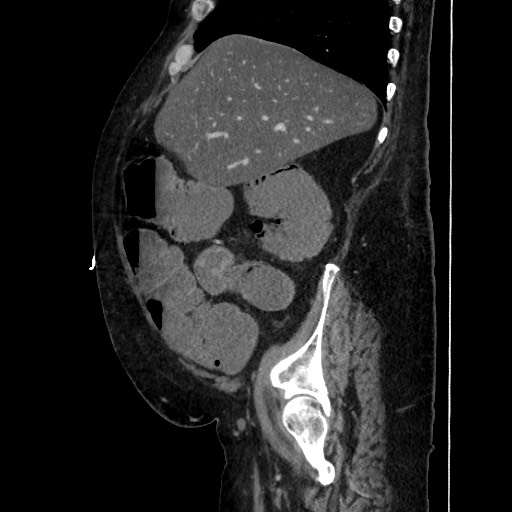 Obstructive colonic diverticular stricture (Radiopaedia 81085-94675 C 72).jpg