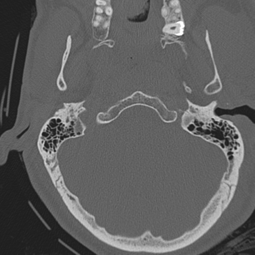 File:Occipital condyle fracture (Radiopaedia 33467-34517 Axial bone window 17).png