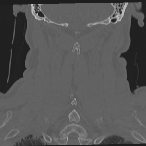 File:Occipital condyle fracture (Radiopaedia 33467-34517 Coronal bone window 52).png