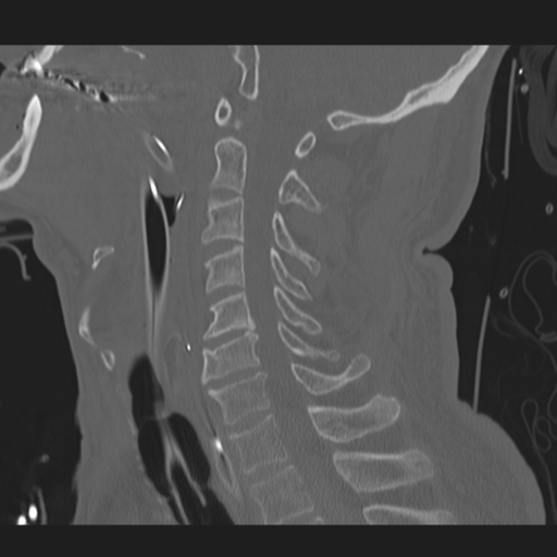 File:Occipital condyle fracture (Radiopaedia 33467-34517 Sagittal bone window 40).png