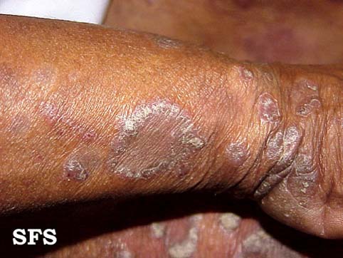 File:Psoriasis (Dermatology Atlas 9).jpg