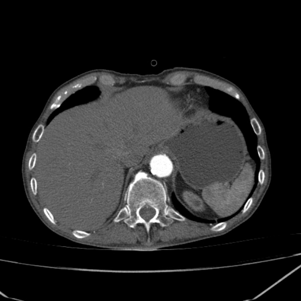 Abdominal aortic aneurysm (Radiopaedia 23703-23856 Axial C+ arterial phase 6).jpg