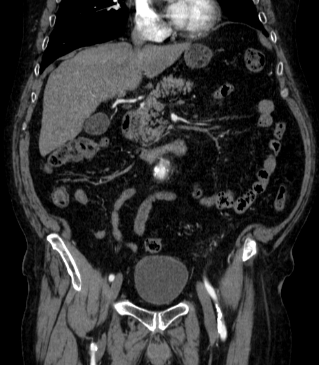 Abdominal aortic aneurysm (Radiopaedia 25855-26001 Coronal C+ arterial phase 19).jpg