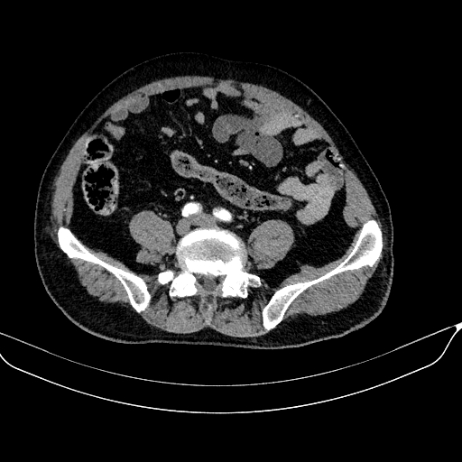 Abdominal aortic aneurysm (Radiopaedia 67117-76452 Axial C+ arterial phase 94).jpg