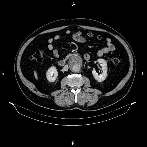 Abdominal aortic aneurysm (Radiopaedia 83094-97462 Axial renal excretory phase 50).jpg