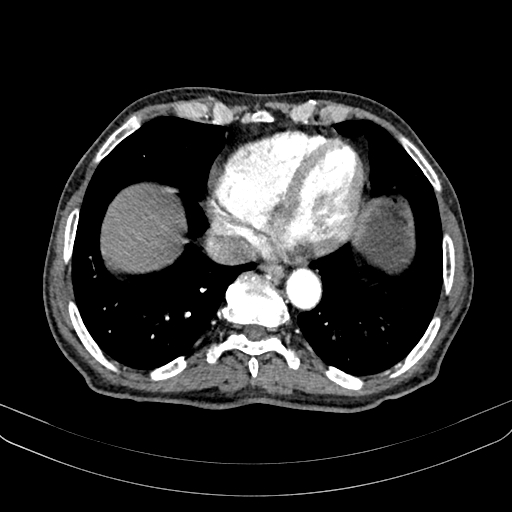 Abdominal aortic aneurysm (Radiopaedia 83581-98689 Axial C+ arterial phase 11).jpg