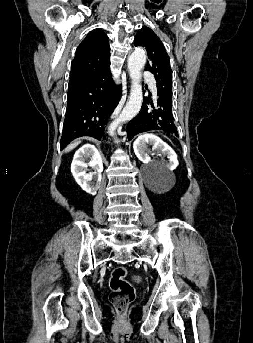 Abdominal aortic aneurysm (Radiopaedia 85063-100606 Coronal C+ arterial phase 41).jpg