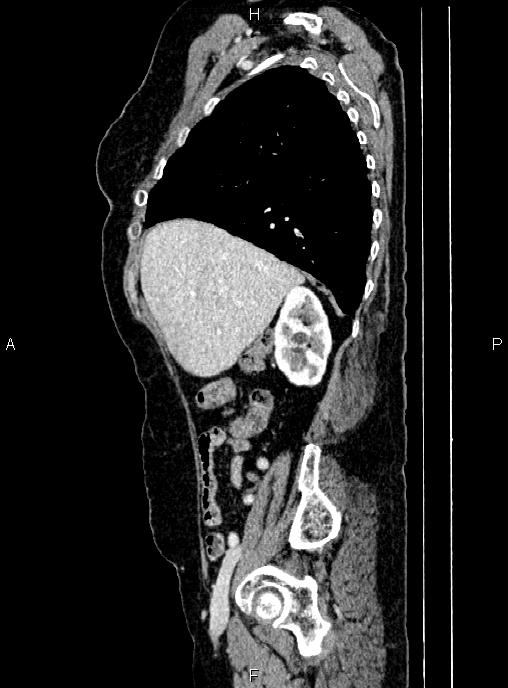 Abdominal aortic aneurysm (Radiopaedia 85063-100606 Sagittal C+ arterial phase 20).jpg