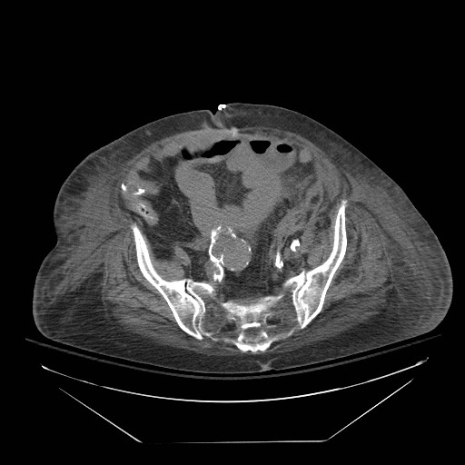 Abdominal aortic aneurysm - impending rupture (Radiopaedia 19233-19247 Axial non-contrast 128).jpg