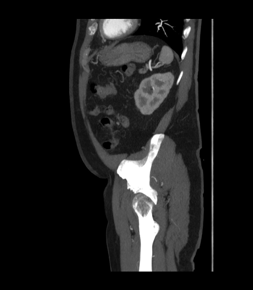 Abdominal aortic aneurysm with thrombus fissuration (Radiopaedia 46218-50618 Sagittal C+ arterial phase 48).jpg