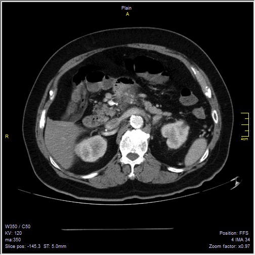 Abdominal aortic aneurysm with thrombus fissuration (Radiopaedia 47340-51926 Axial C+ arterial phase 18).jpg