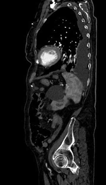 Abdominal aortic aneurysm with thrombus fissuration (Radiopaedia 73192-83919 Sagittal C+ arterial phase 28).jpg