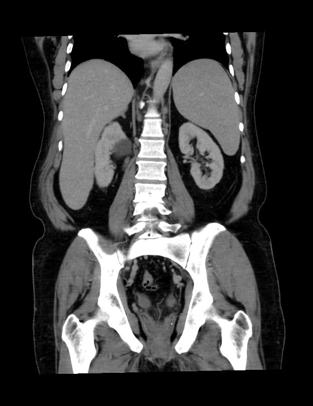Abdominal lymphoma - with sandwich sign (Radiopaedia 53486-59492 C+ portal venous phase 20).jpg