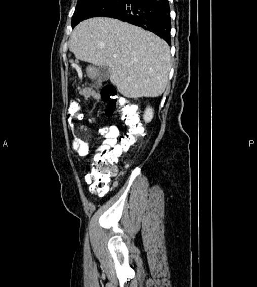 File:Abdominal lymphoma with sandwich sign (Radiopaedia 84378-99704 Sagittal C+ portal venous phase 14).jpg