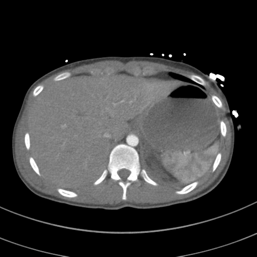 File:Abdominal multi-trauma - devascularised kidney and liver, spleen and pancreatic lacerations (Radiopaedia 34984-36486 Axial C+ arterial phase 79).png