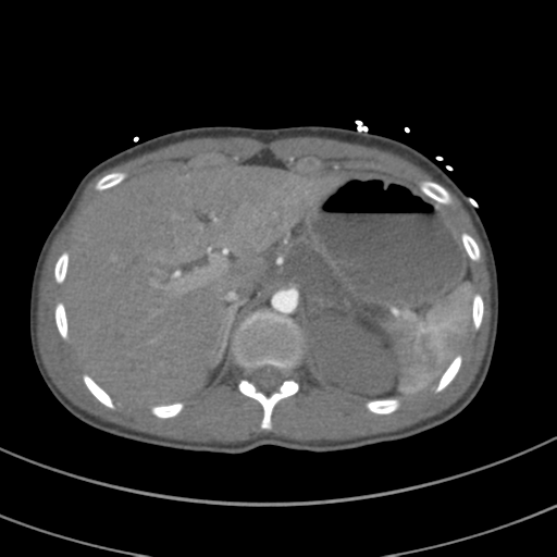 File:Abdominal multi-trauma - devascularised kidney and liver, spleen and pancreatic lacerations (Radiopaedia 34984-36486 Axial C+ arterial phase 87).png