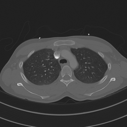 File:Abdominal multi-trauma - devascularised kidney and liver, spleen and pancreatic lacerations (Radiopaedia 34984-36486 I 26).png