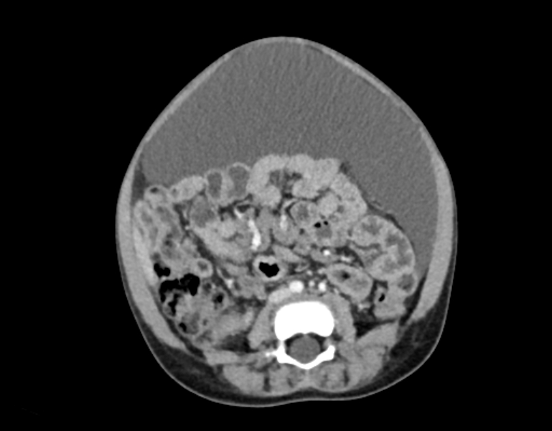 Abdominal premesenteric cystic lymphangioma (Radiopaedia 82995-97350 Axial C+ portal venous phase 36).jpg